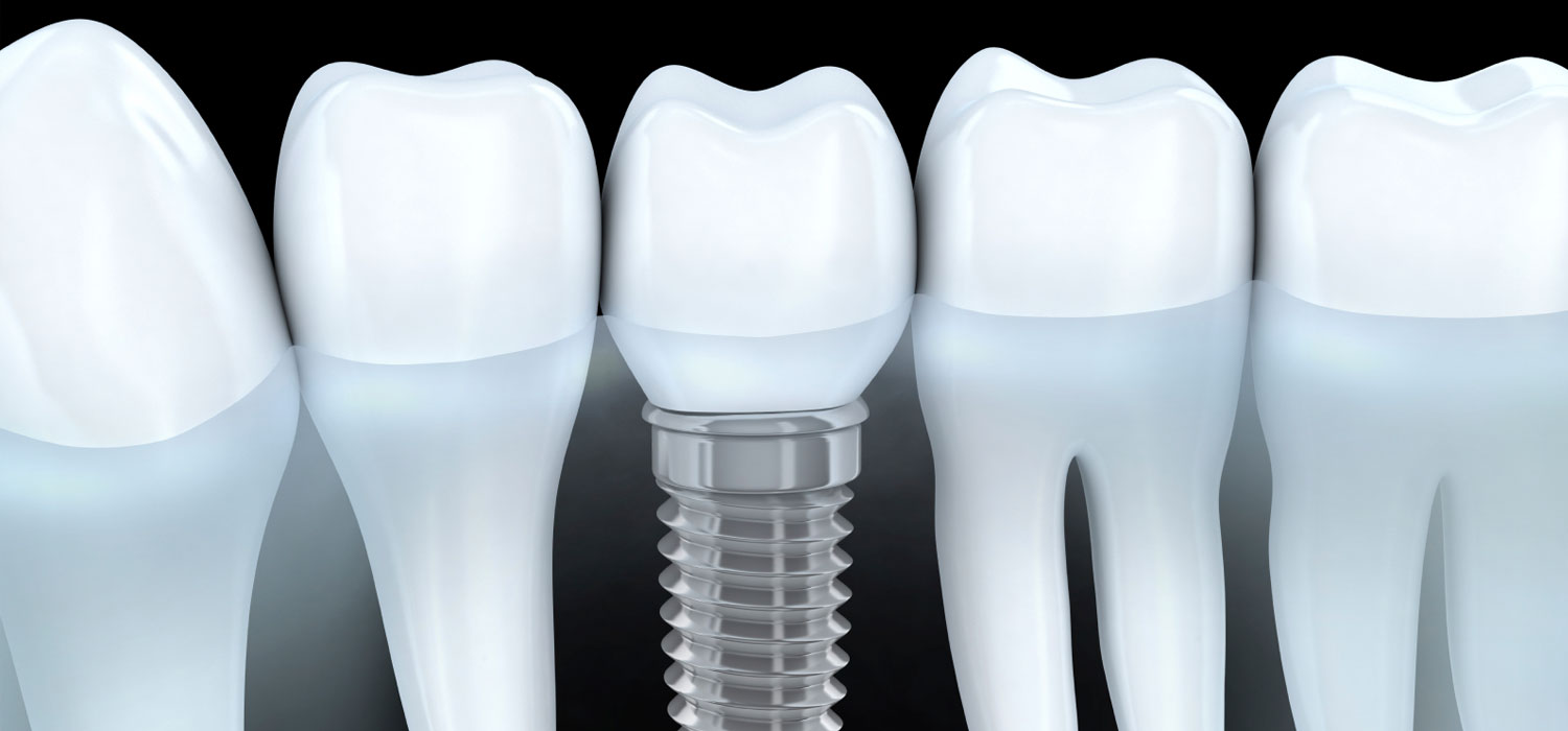 dental implant