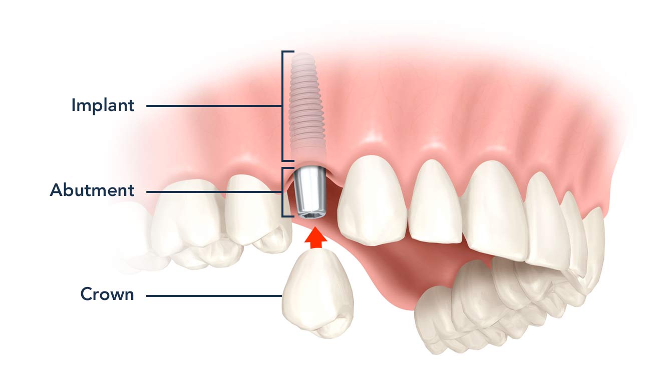 tooth implant components